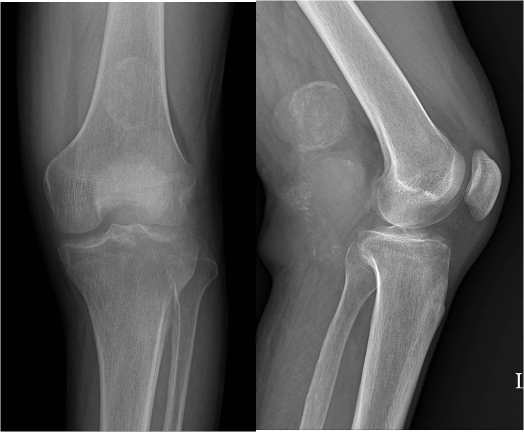 SOFT TISSUE TUMOURS