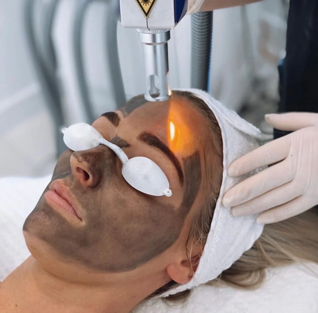 CARBON LASER FACIAL
