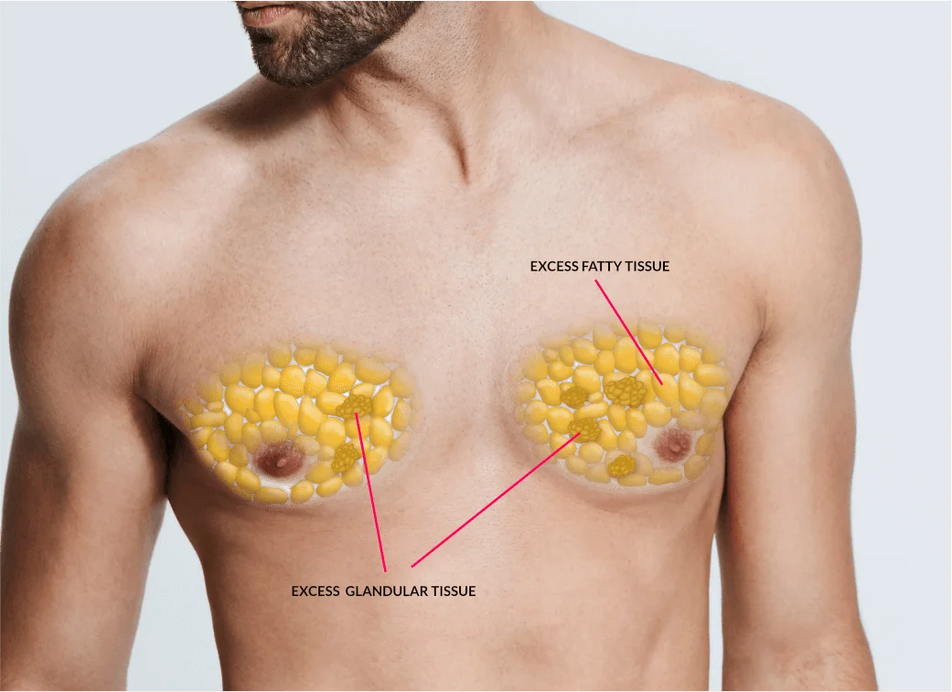 GYNAECOMASTIA