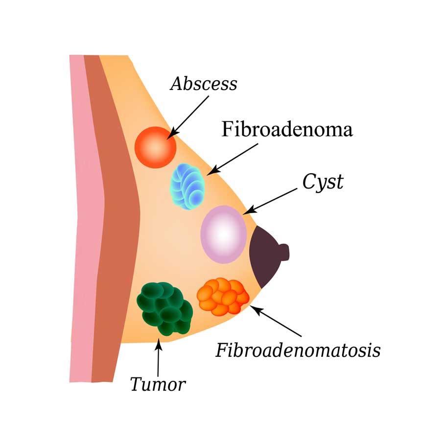 BENIGN BREAST CONDITIONS
