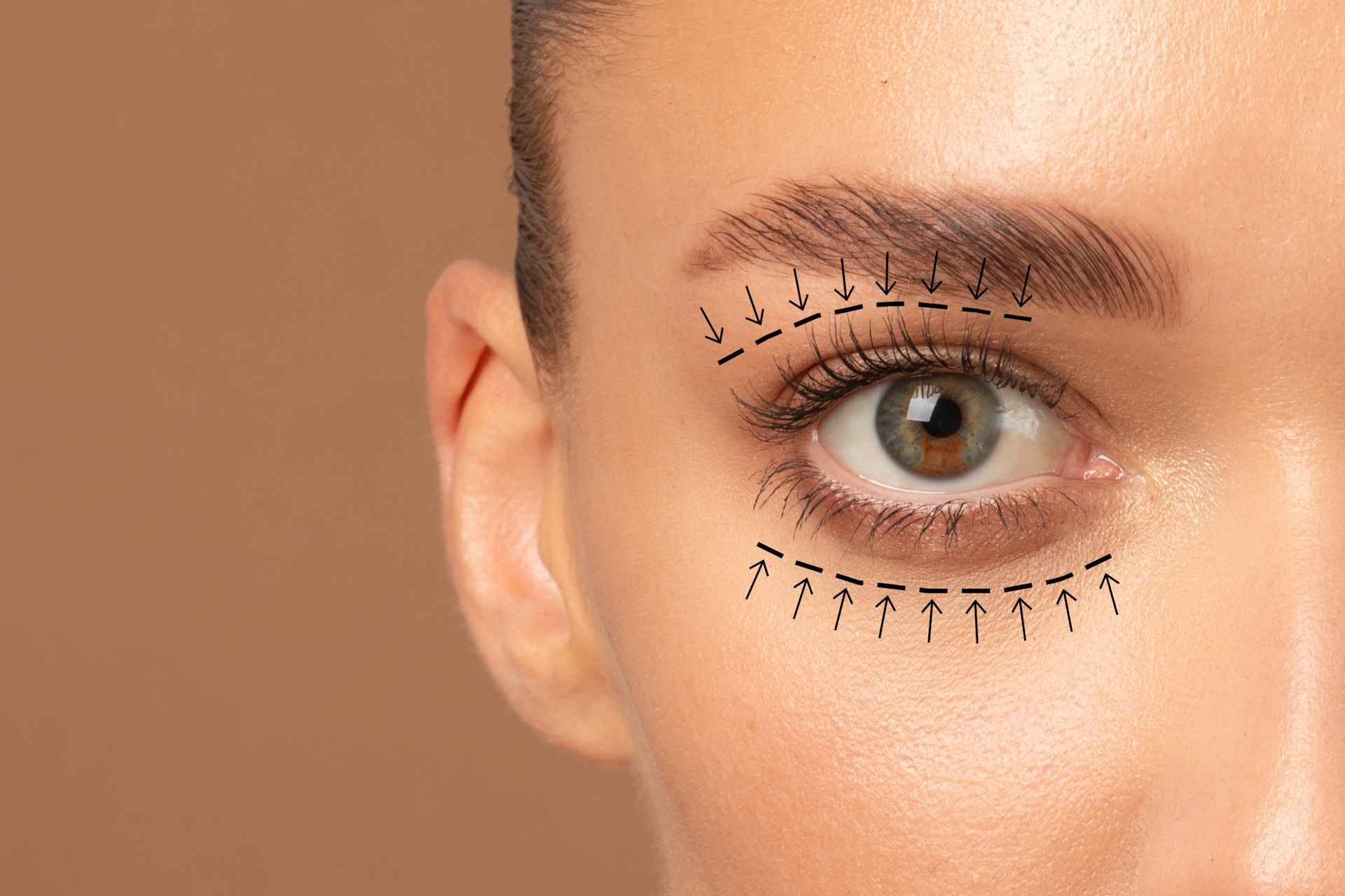 BLEPHAROPLASTY — EYELID SURGERY
