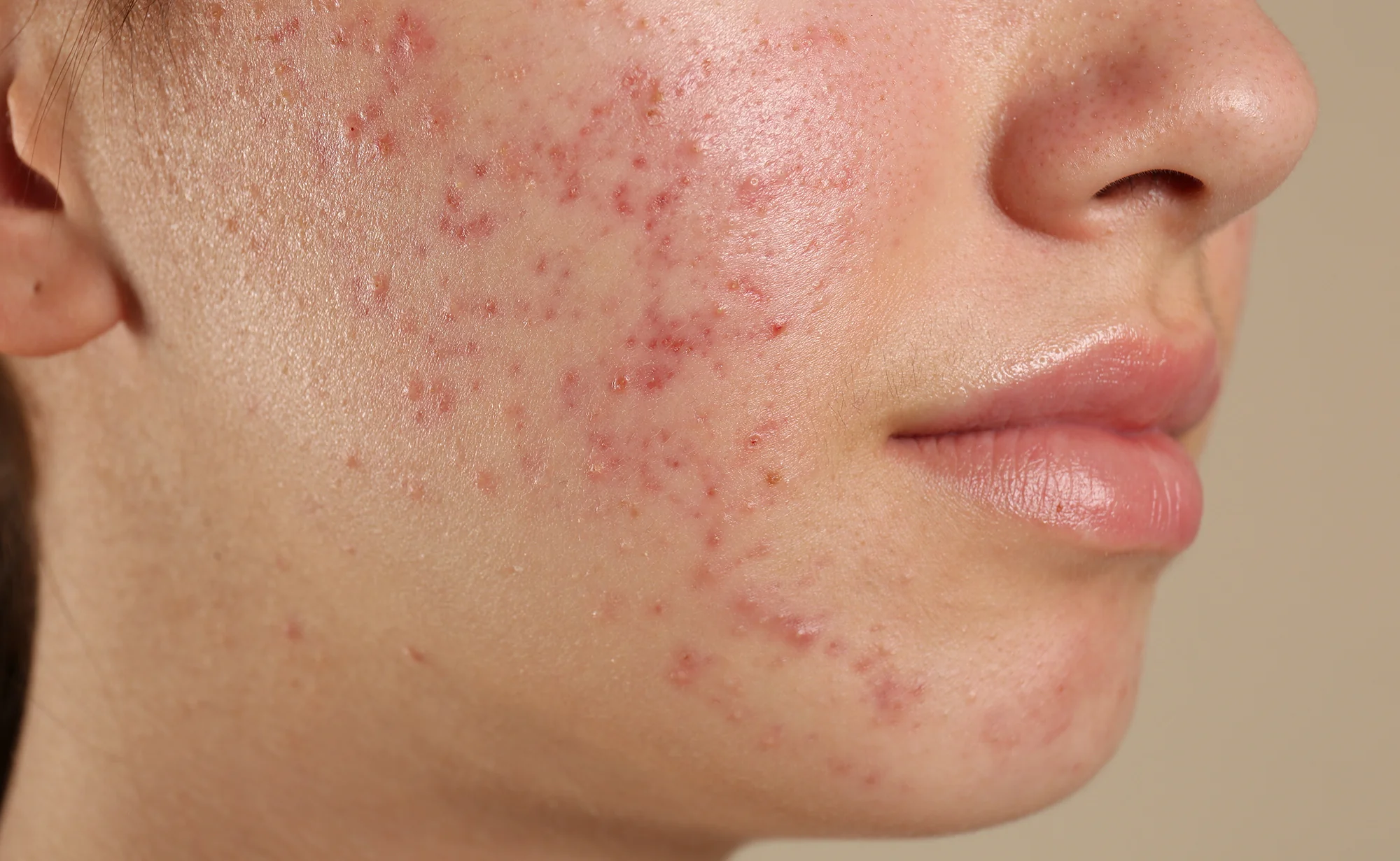 ACNE MANAGEMENT