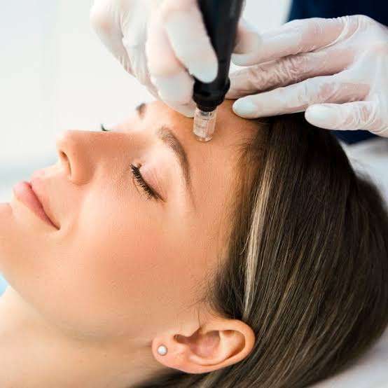MICRO-NEEDLING
