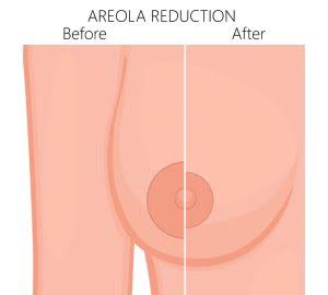 AREOLA REDUCTION