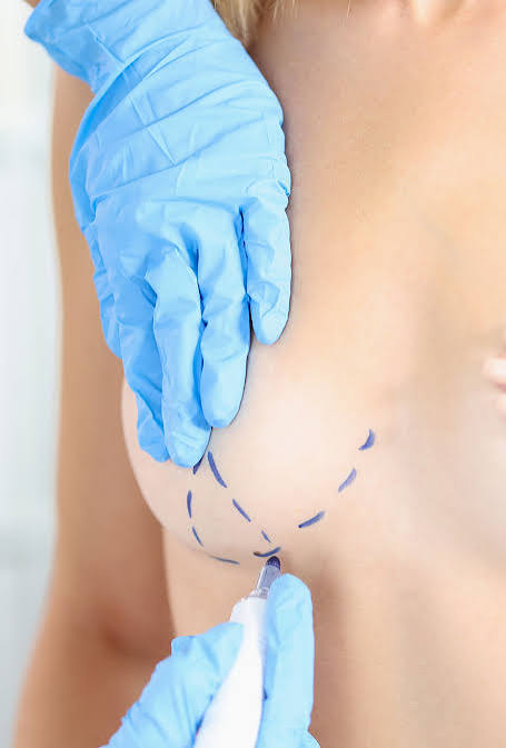 BREAST REDUCTION