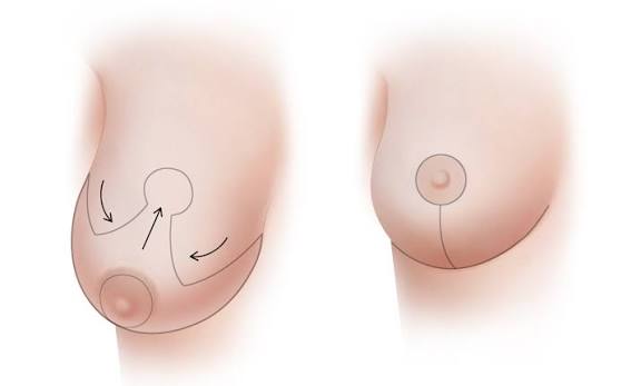 BREAST LIFT