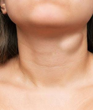 HEAD & NECK LUMPS
