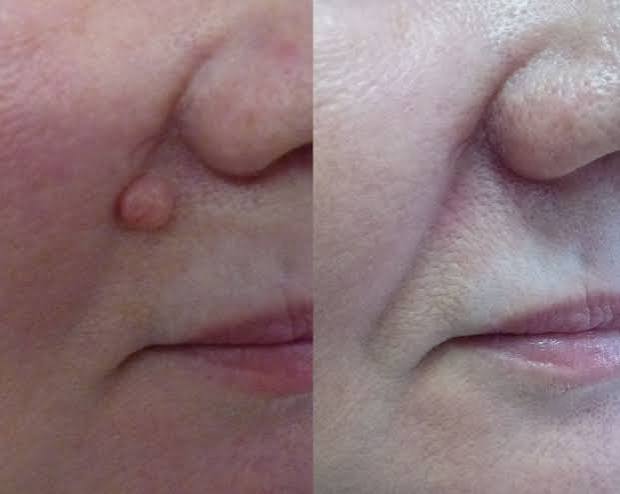 MOLE REMOVAL