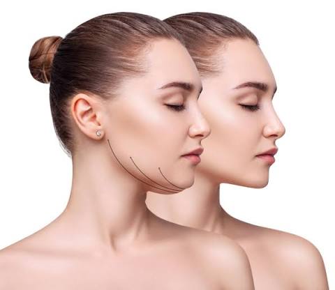 BUCCAL FAT REDUCTION & FACIAL SLIMMING