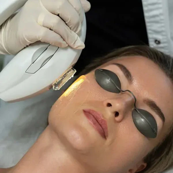 IPL — INTENSE PULSED LIGHT THERAPY