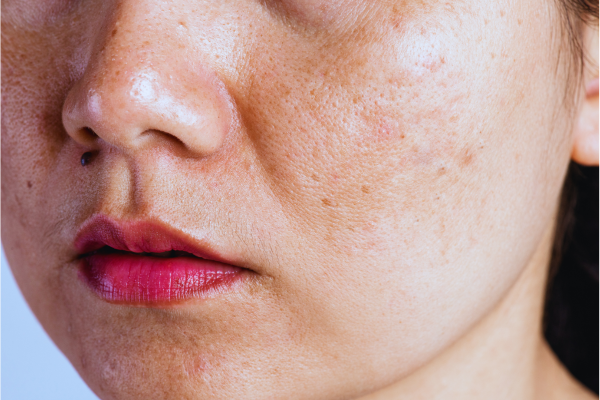 PIGMENTATION & MELASMA TREATMENT