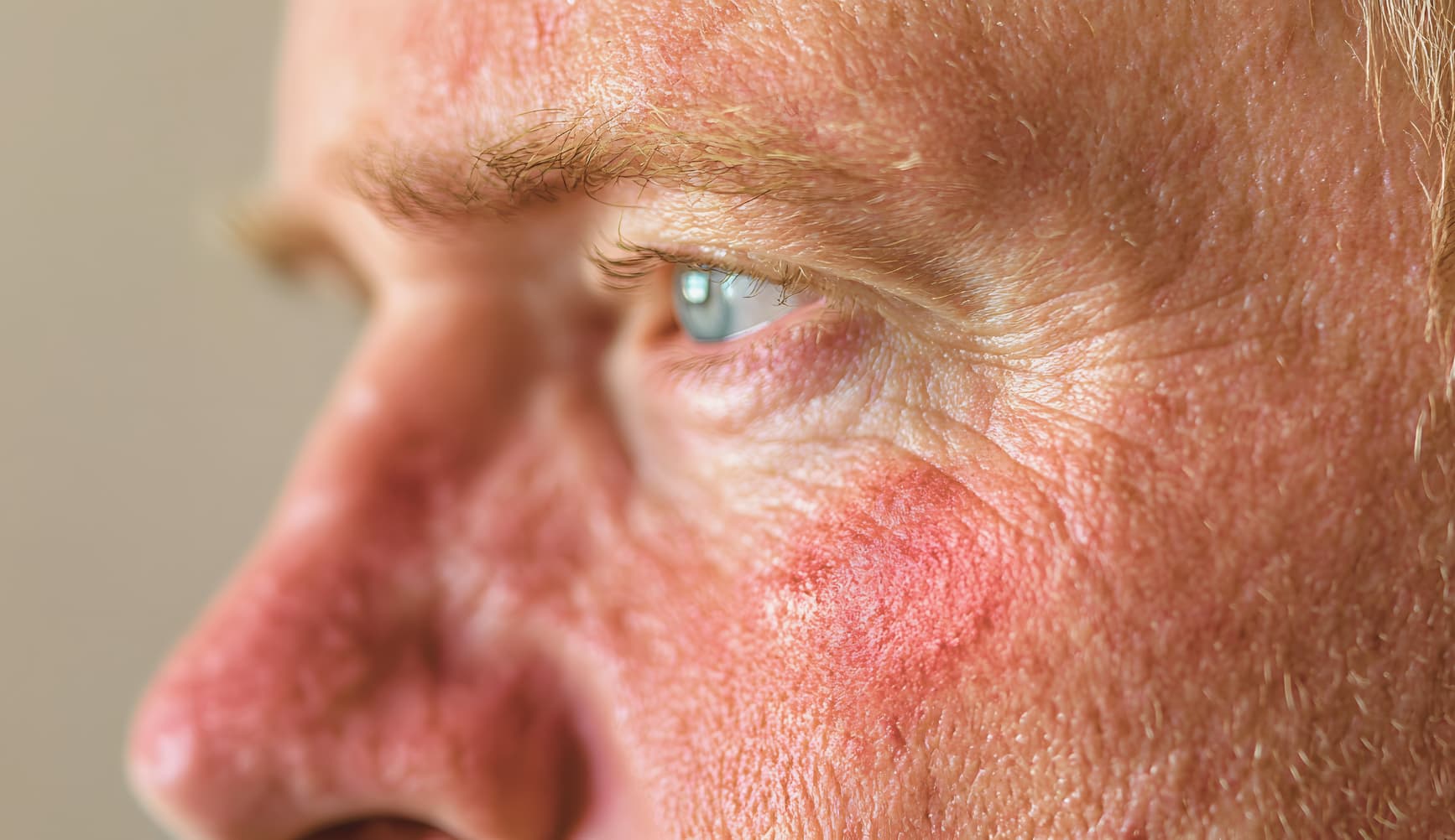 ROSACEA