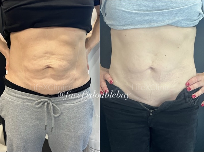 2 x Fat Freezing + 1 RF