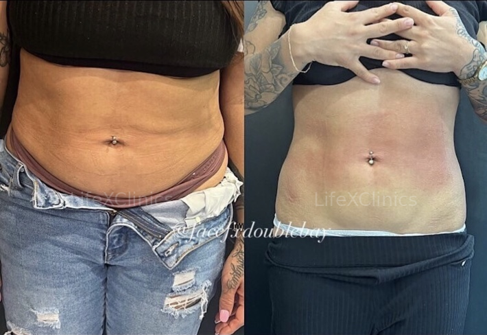 After 3 x Fat Freezing