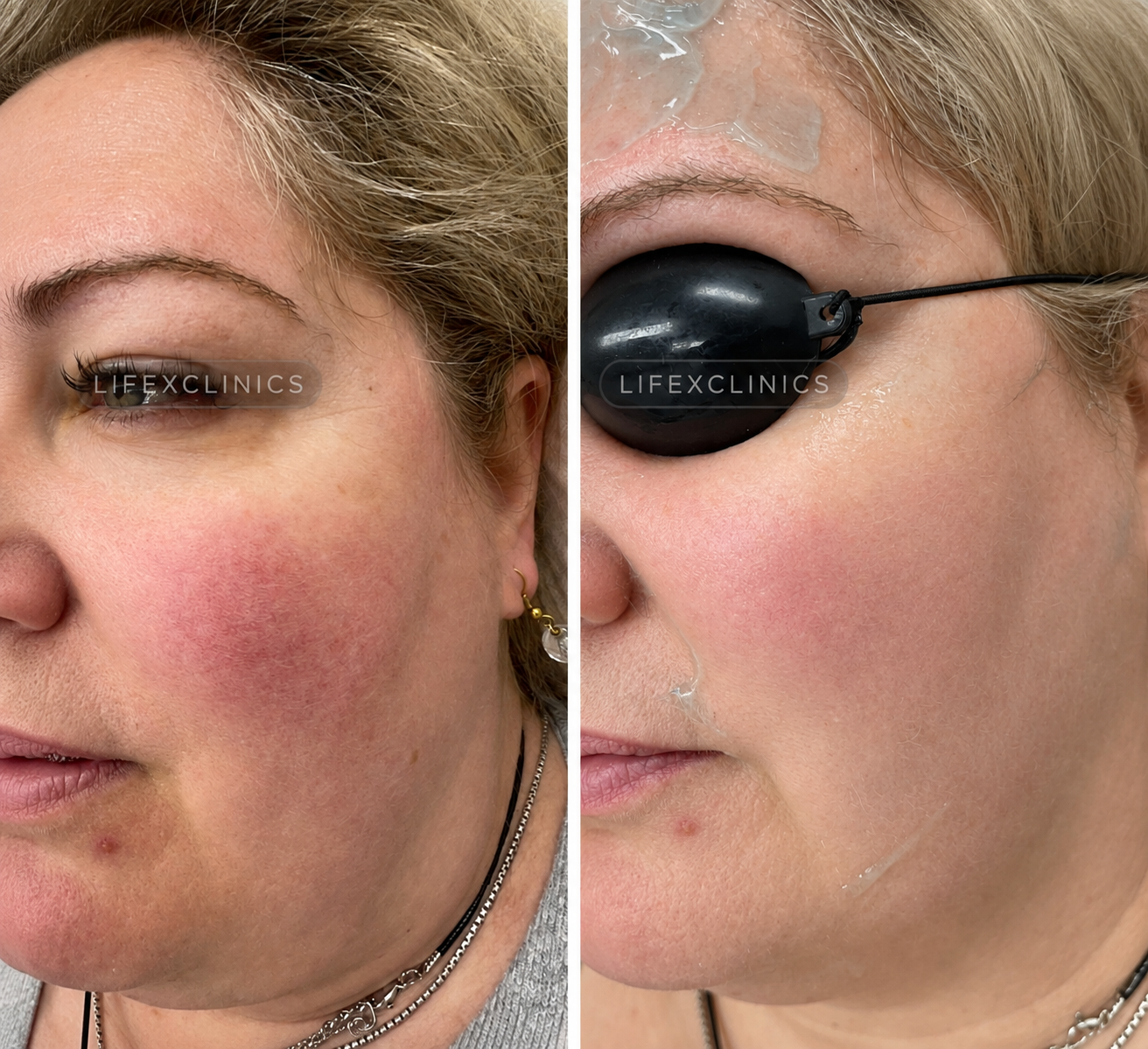 Before and after