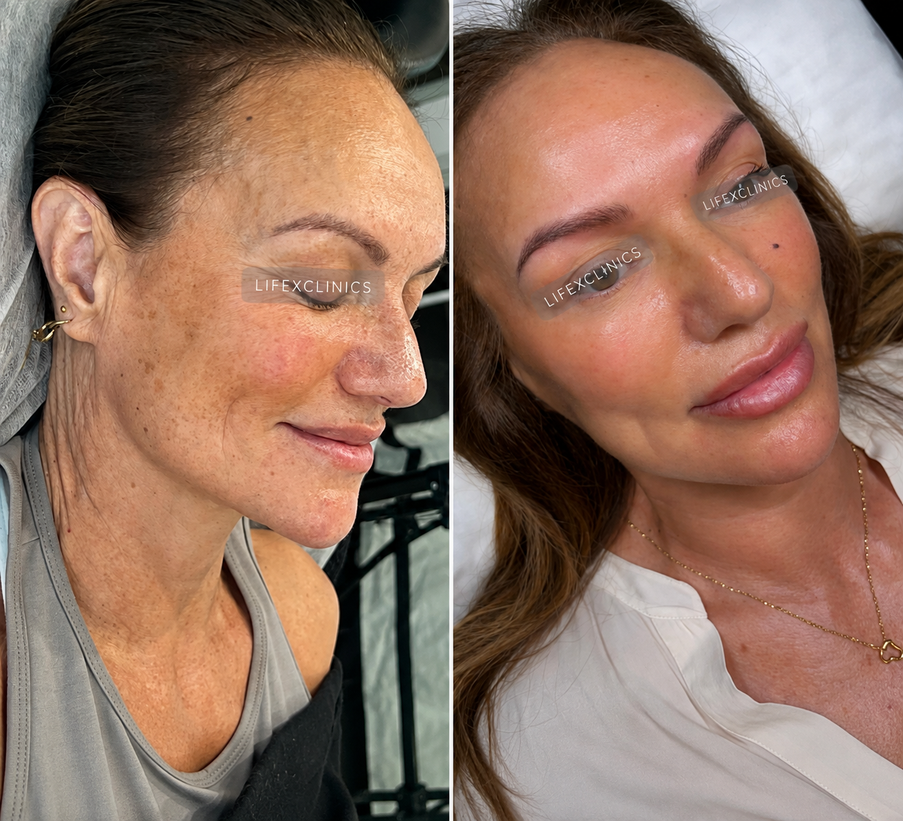 Before and After