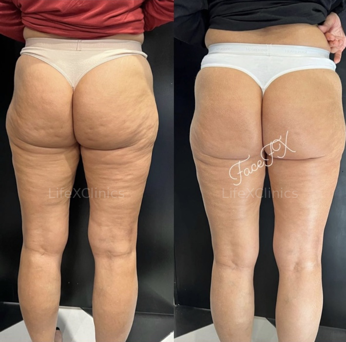 Post 3 x Fat Freezing + RF