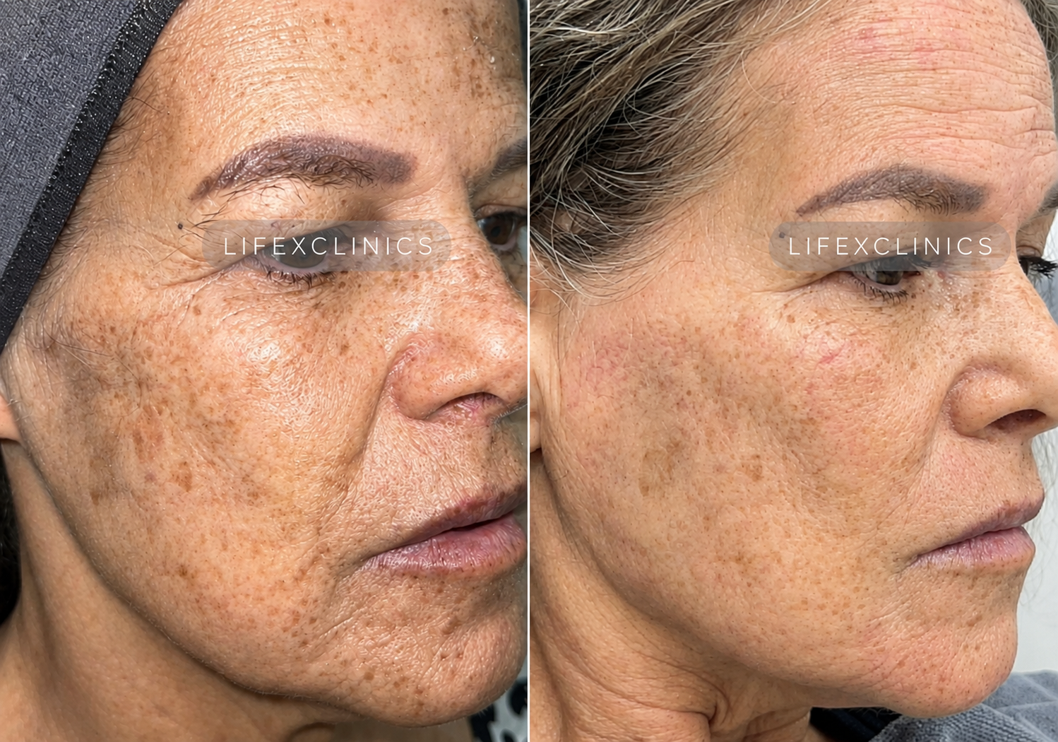 Post 2 x Exosomes Micro-needling