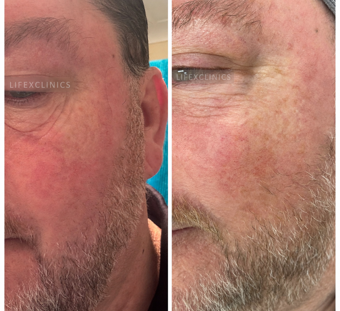 Before and After