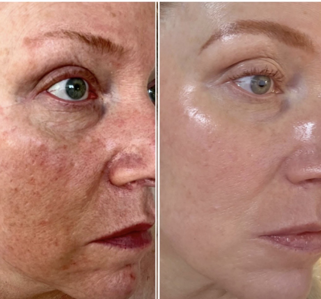 Rosacea Management
