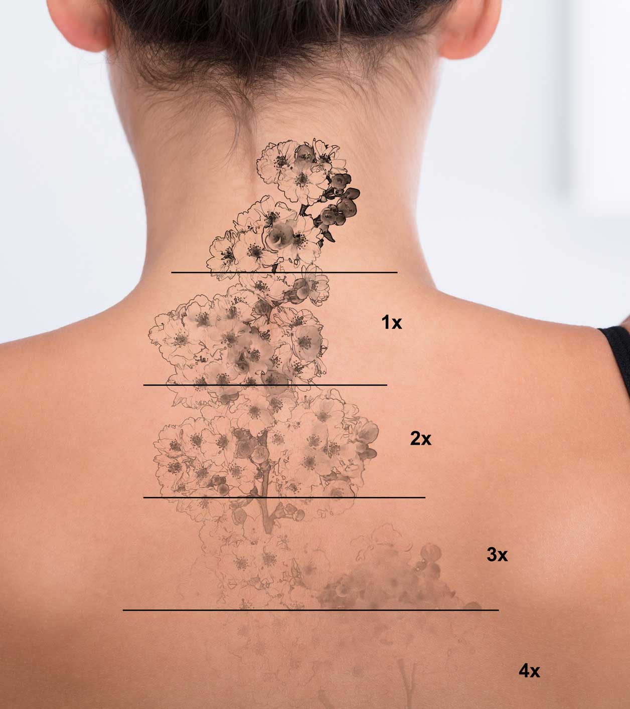 TATTOO REMOVAL